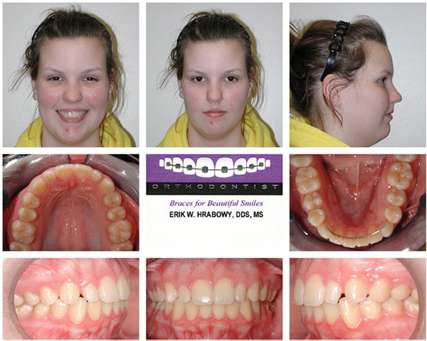 Image After Blonde Girl Hrabowy Orthodontics Columbus Grove City OH