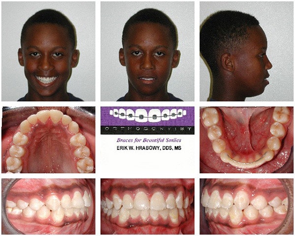 Image After Black Haired Boy Hrabowy Orthodontics Columbus Grove City OH