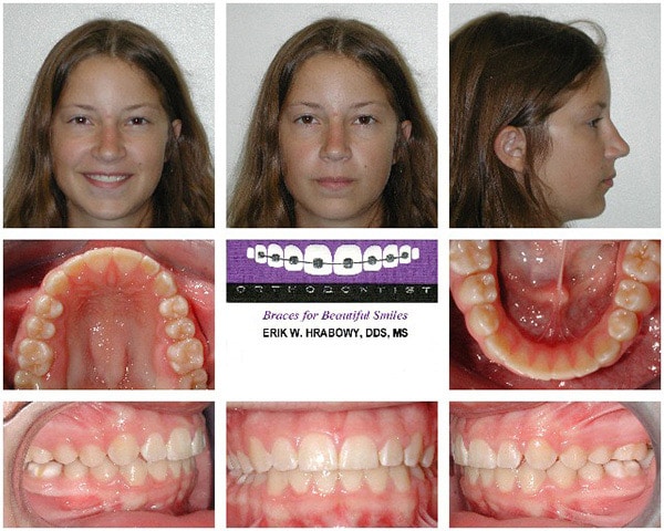 After Image Brunette Girl Hrabowy Orthodontics Columbus Grove City OH