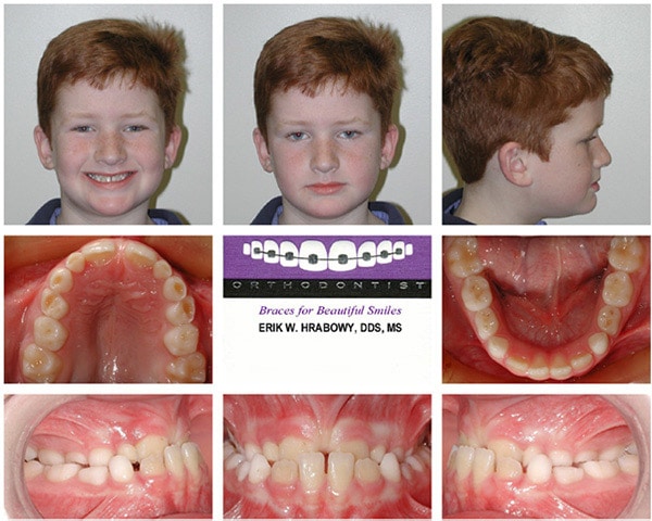 Image Early Treatment Red Head Boy Hrabowy Orthodontics Columbus Grove City OH